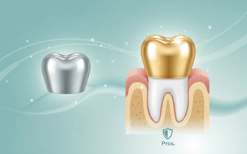 Illustration related to Metal Crowns (Gold Alloys, Base-Metal Alloys)