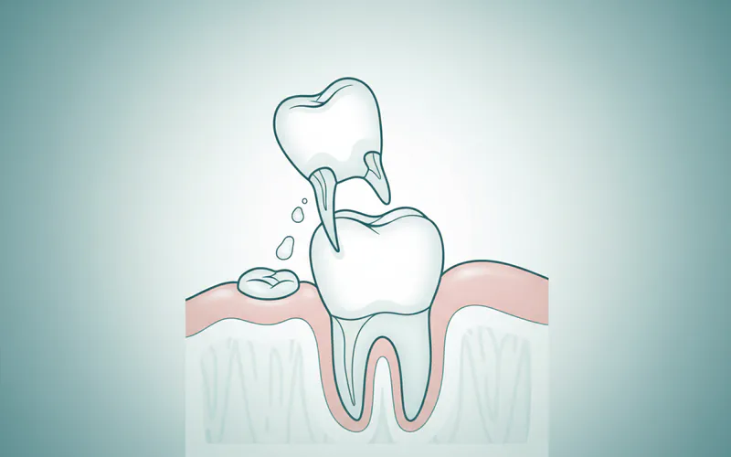 Illustration related to What It Is / Overview: The Exfoliation Process