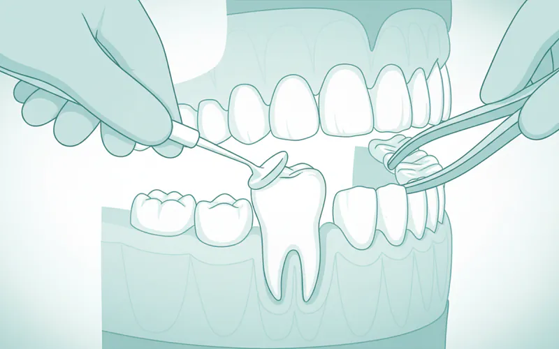 Illustration related to The Primary Treatment: Extraction