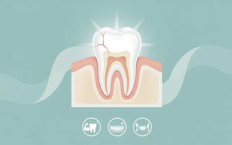 Illustration related to Zirconia Crown: Complete Guide