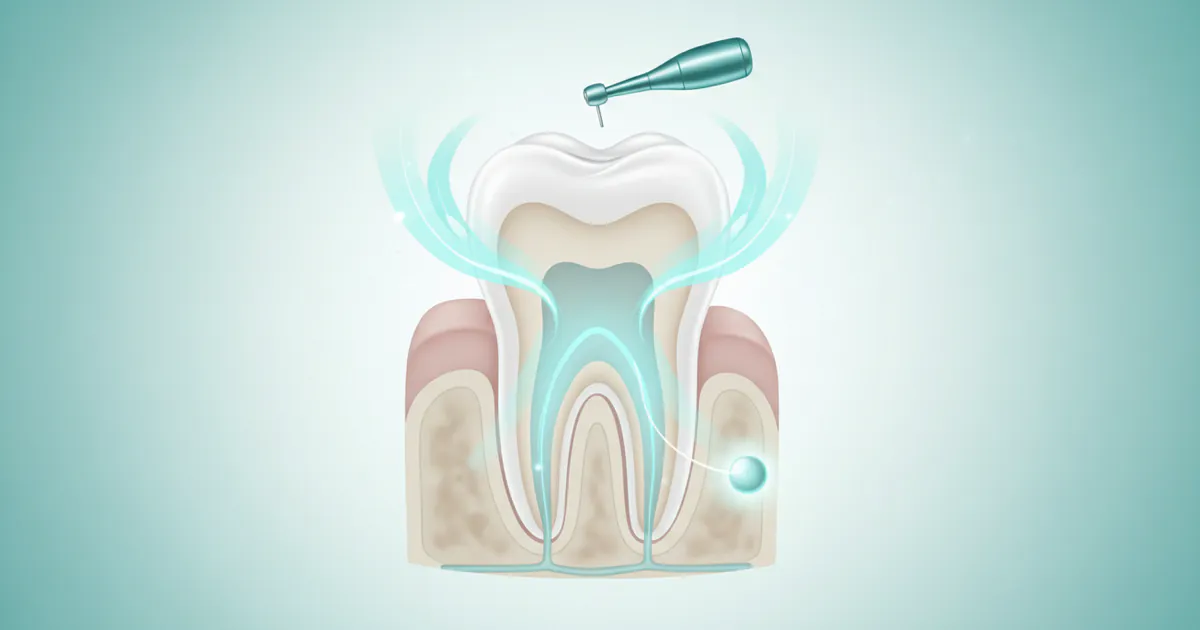 Is a Root Canal Painful