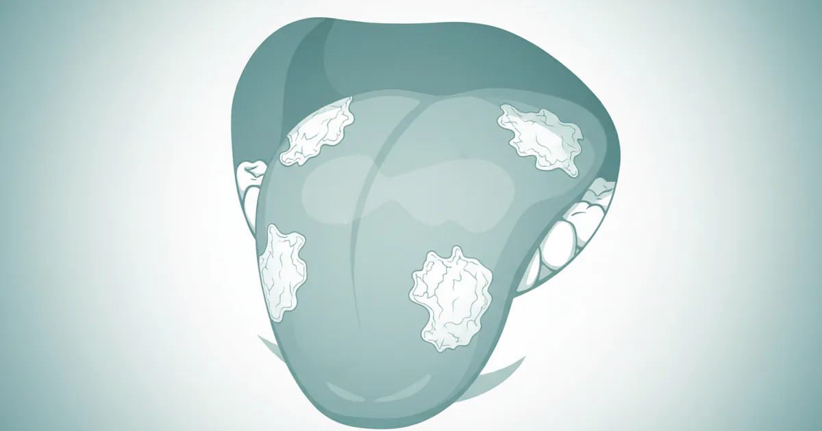 Leukoplakia Tongue: Complete Guide