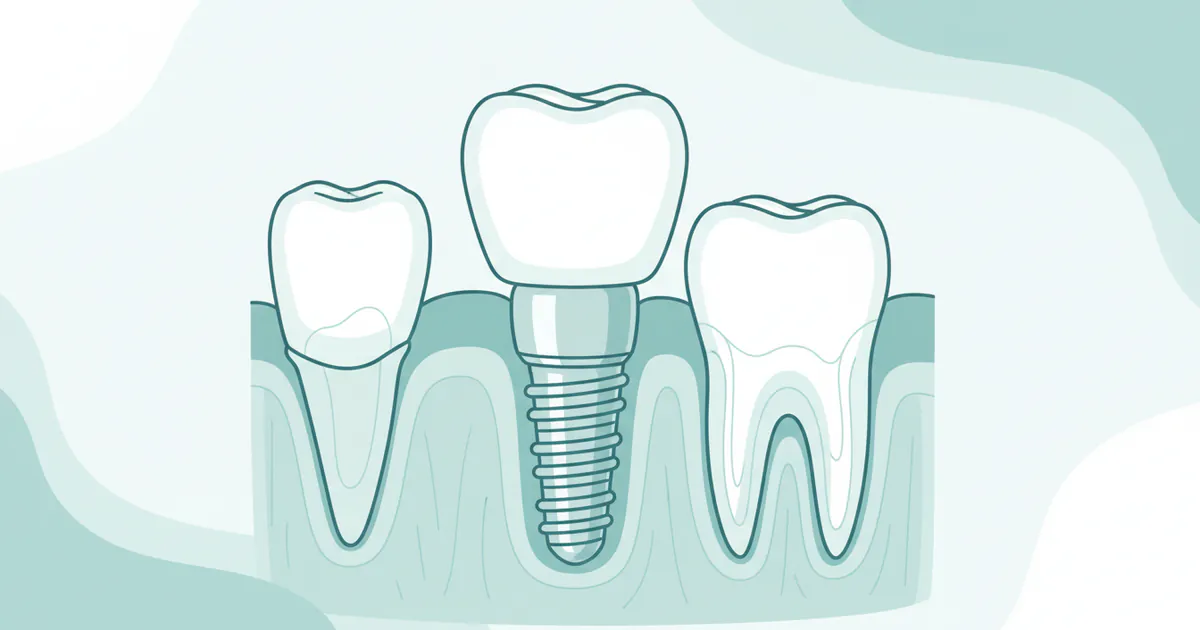 Molar Implant: Complete Guide