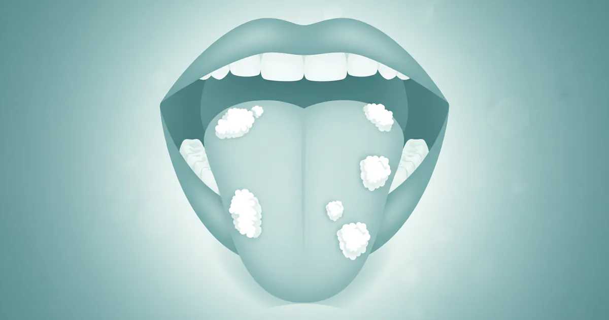 Oral Candidiasis Symptoms: Complete Guide