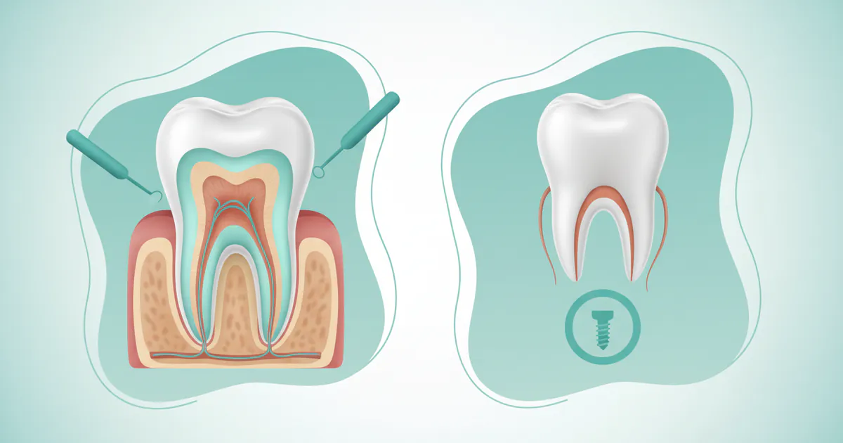 Root Canal vs Extraction: Complete Comparison Guide