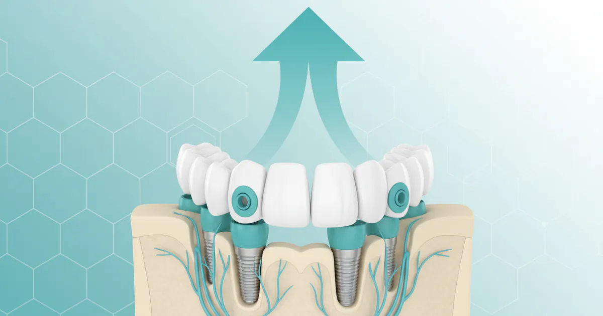 Snap in Dentures Cost: Complete Price Guide 2026