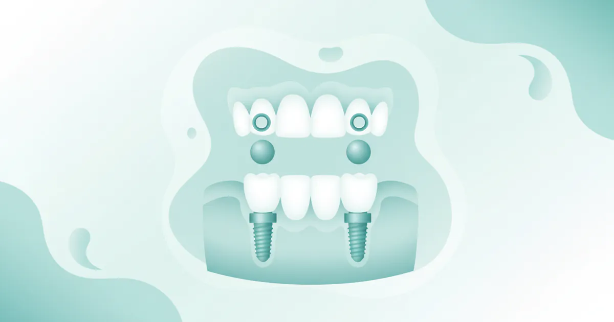 Snap-in Dentures Cost Near Me: Complete Price Guide 2026