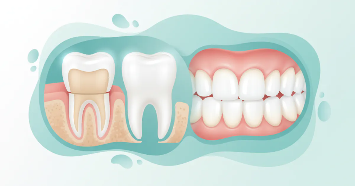 Teeth Veneers: Complete Guide