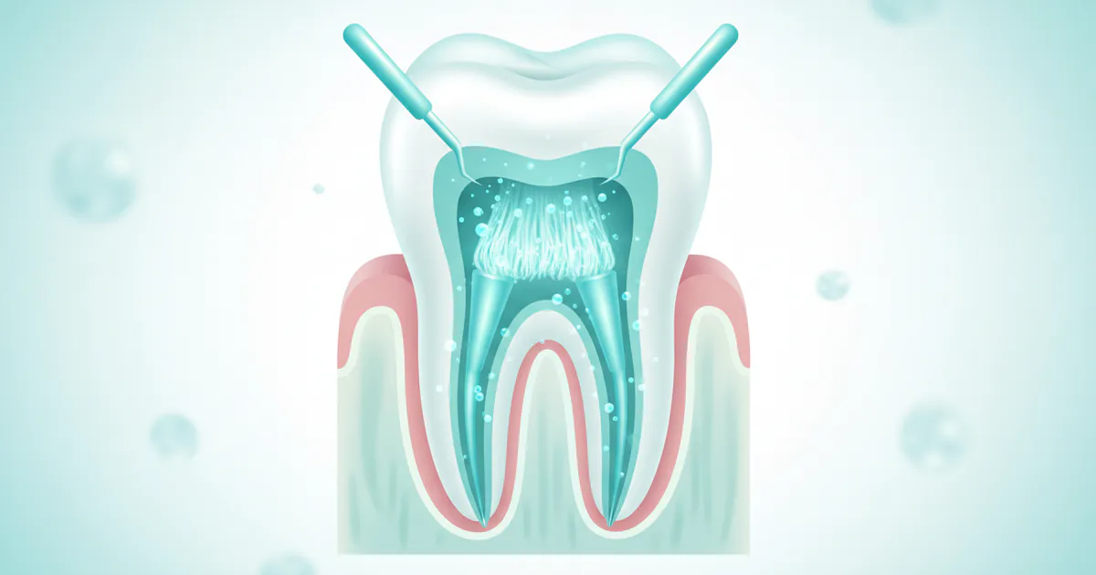 What Does a Root Canal Look Like