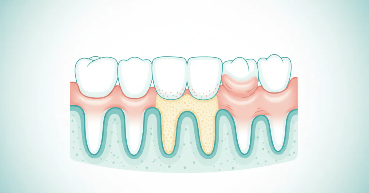 What Does Gingivitis Look Like