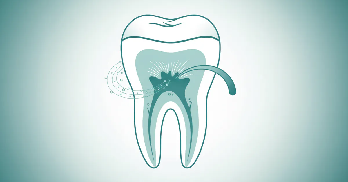 What Is a Root Canal?