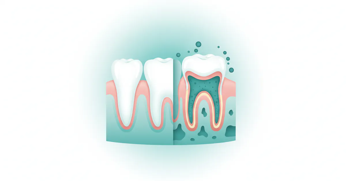 What Is Periodontal Disease